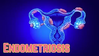 Endometriosis (Update 2018) - CRASH! Medical Review Series