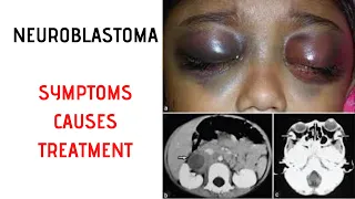 NEUROBLASTOMA Symptoms, Signs, Causes, Treatment