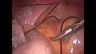 Veichetti's  laparoscopic  vaginoplasty  br Dr.Ramesh. B
