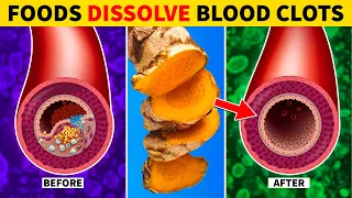 Top 7 Foods That Dissolve Blood Clots