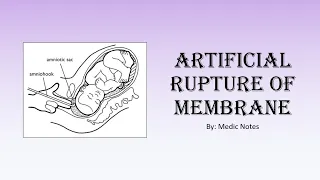 [Houseman preparation procedures] Artificial rupture of membrane - procedural steps