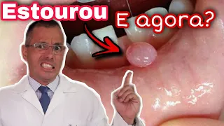 🤦‍♂️A BOLHA NO LÁBIO | MUCOCELE estourou e piorou! E agora? O que fazer?