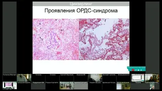 COVID-19: патоморогенез и патологическая анатомия