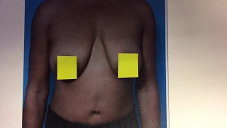 Breast Lift without Implants- Detroit, Michigan -  Dr. Anthony Youn