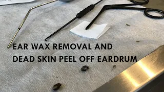 526 - Ear Wax Removal & Skin Peel off Eardrum Otitis Externa Ears