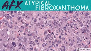 Atypical Fibroxanthoma (AFX) vs Pleomorphic Dermal Sarcoma (PDS): 5-Minute Pathology Pearls