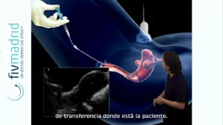 Transferencia embrionaria en FIV