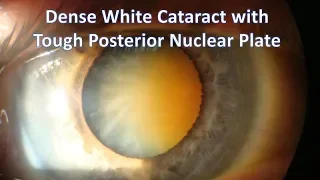 White Cataract: Solution for the Dense Posterior Nuclear Plate