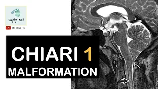 Chiari 1 malformation (MRI)