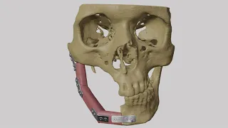 Mandibular Reconstruction using Fibula Graft