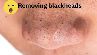 best blackhead removal 😧😳 removing blackheads #blackheads #satisfying