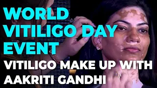 How to cover vitiligo patches|Dr Nitika Kohlivitiligo makeup