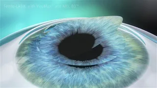 LASIK Eye Surgery Animation