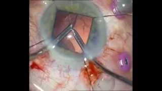 Traumatic cataract after intravitreal anti-VEGF injection.