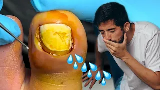 NASTY GOOEY TOE NAIL POP