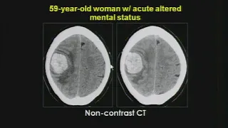 Brain Tumors cases