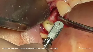 IMPLANTOLOGY - REX CASE REPORT - Implant positioned in 4/5 mm crestal bone - Tomaso Vercellotti