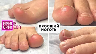 Педикюр 🌸 Вросший ноготь 🌸 Обработка пальцев ног 🌸 Ирина Брилёва