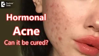Can Hormonal Acne be cured? - Dr. Rasya Dixit