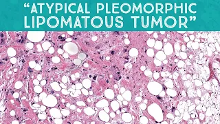 "Atypical pleomorphic lipomatous tumor" (mimic of liposarcoma) (AIP France 2021 - case 13)