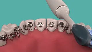 Brush & Floss Easily with InBrace