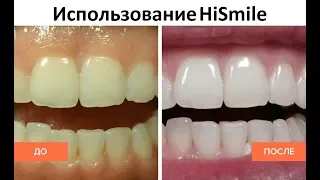 HiSmile - домашнее отбеливание зубов