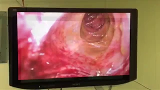 Laparoscopic LAR with variant vascular anatomy and blood supply assessment usig ICG