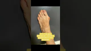 Fixing a Bunion - AMI Bunion Technique