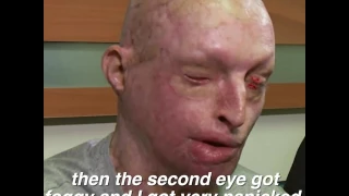 UK acid attack victim speaks about his experience