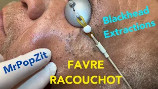 Favre Racouchot syndrome.Dozens of comedones extracted.Whiteheads and blackheads. Clearing the pores