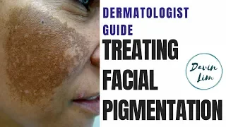 How to treat PIGMENTATION