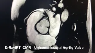 DrRaviRT - CMR Videos - Unicommissural Aortic Valve