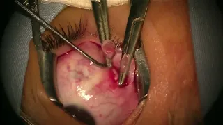 Surgery: Left Inferior Oblique Myectomy