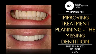 SPG Webinar: Improving Treatment Planning - The Missing Dentition