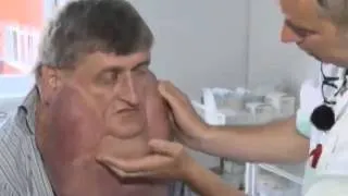 Словацкие доктора удалили пациенту гигантскую опухо...
