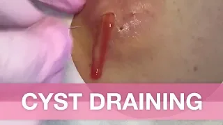 Cyst Draining - Avert your eyes if you're easy queasy