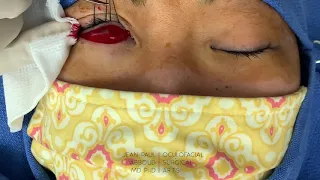 Surgical Repair of Lower Eyelid Epiblepharon