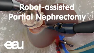 Robot-assisted Partial Nephrectomy (RAPN)