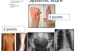 Marfan Syndrome - Diagnosis by Prof Julie De Backer