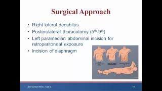 [Keynote Lecture] Thoracoabdominal aortic aneurysm