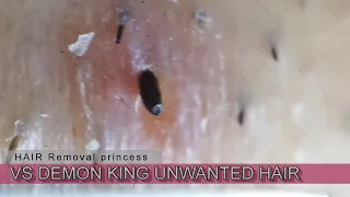 【魔王】Extractions Demon King Ingrown Hair l Tweezers Beard l 2020/9/19