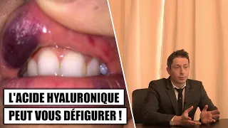 Danger : L'acide hyaluronique peut vous défigurer !