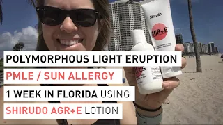 Polymorphous Light Eruption (PMLE) Sun Allergy - 1 week Florida experiment with Shirudo AGR+E