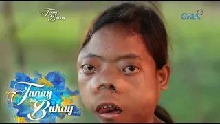 Tunay na Buhay: Binatang may tumor sa mukha, kilalanin