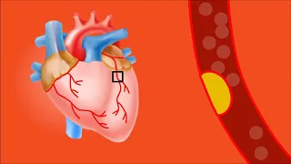 What is a Heart Attack? Differences Between Heart Attack and Cardiac Arrest.
