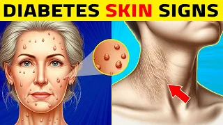 8 Diabetes Skin Signs You Shouldn't Ignore!