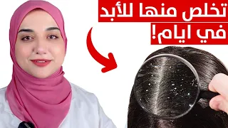 لن تتخلص من قشرة الشعر للأبد الا بهذه الطريقة /علاج نهائى للقشرة والحكة و التهابات فروة الراس..