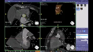 TAVR aortic root measurements with instructions.  Terarecon .  Intuition.