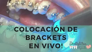 Colocación de Brackets en VIVO / Putting on Braces - LIVE