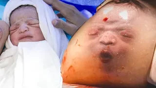 Selten! Dieses Baby kam in seiner Fruchtblase zur Welt